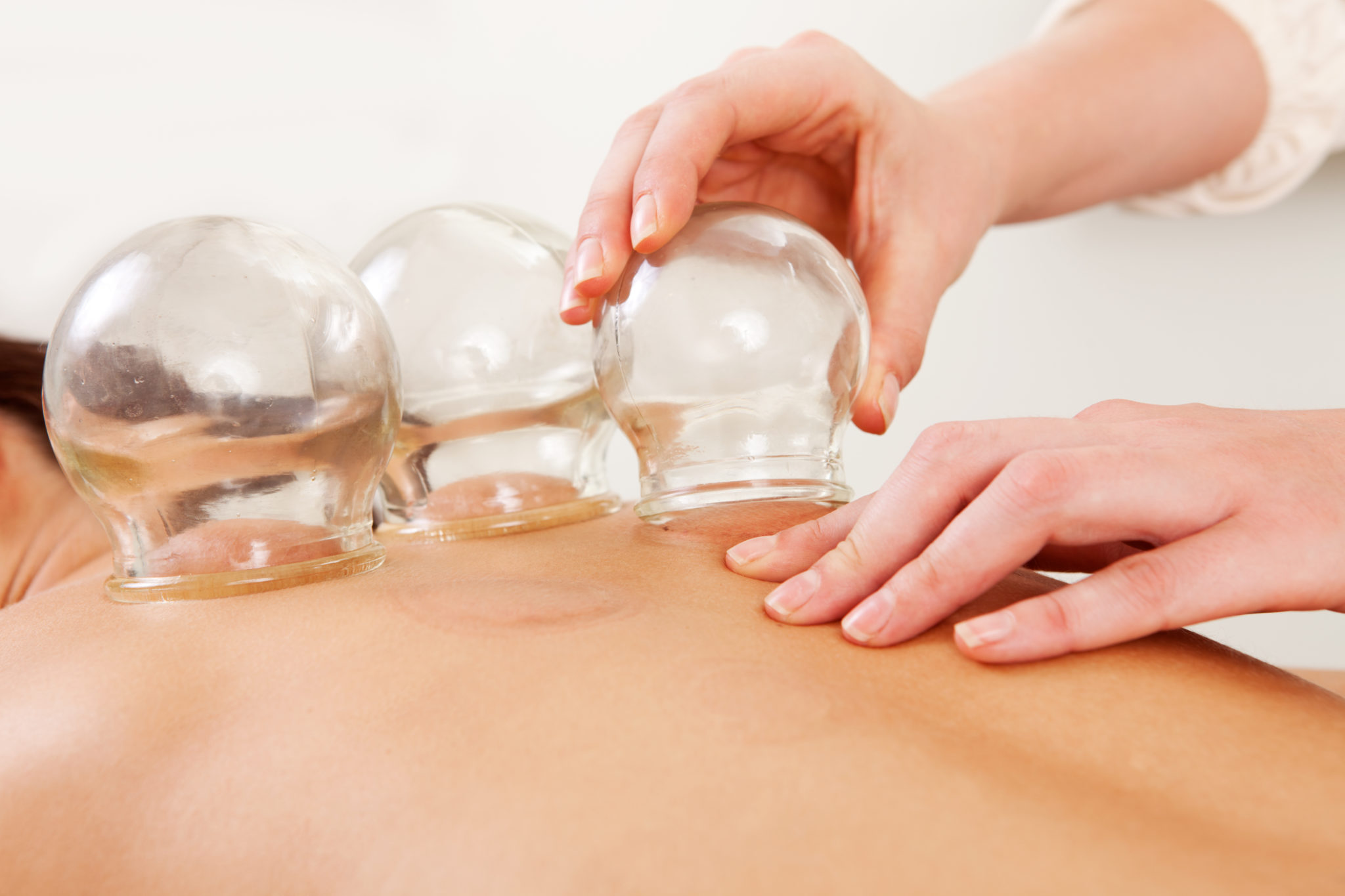 Cupping therapy