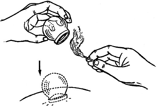Cupping pressure
