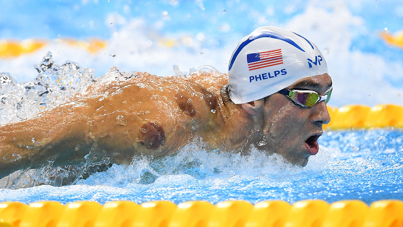 Phelps cupping